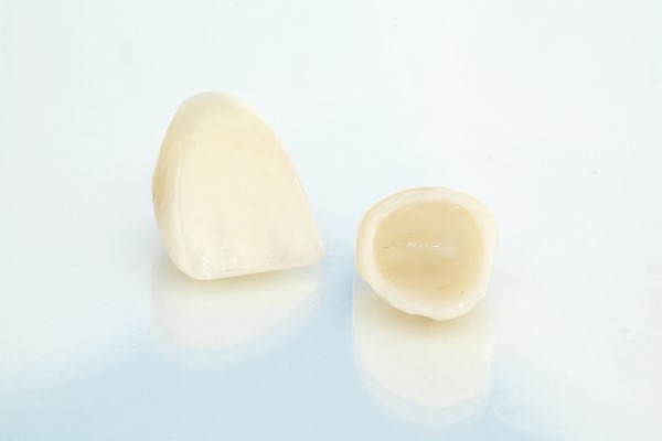 Reasons To Choose CEREC Same Day Crowns