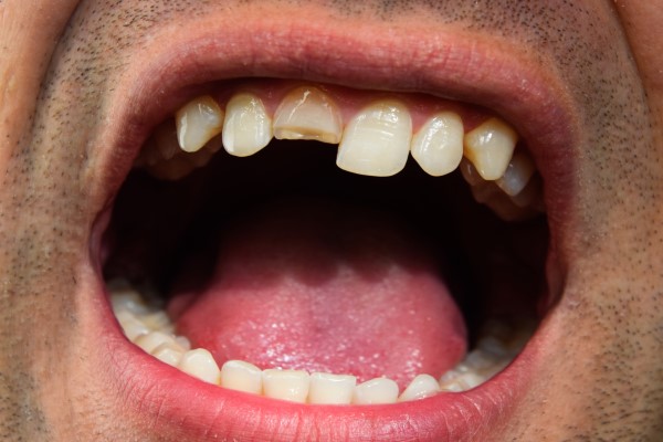 Common Causes Of A Chipped Tooth