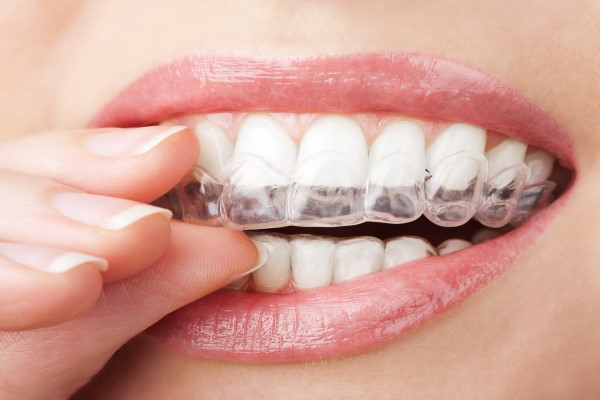 How To Choose Clear Aligners For Adult Teeth Straightening