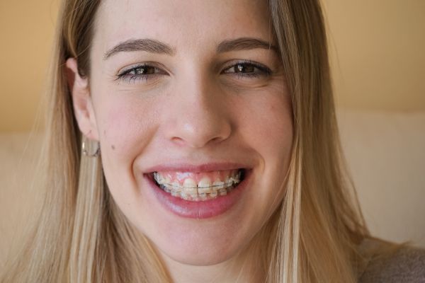 How To Maintain Your Oral Health With Clear Braces From A General Dentist