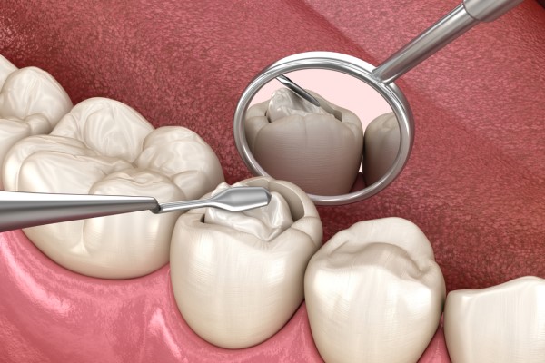 Benefits Of Mercury Free Dentistry
