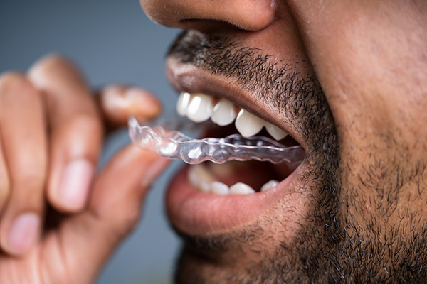 A Cosmetic Dentist Explains Benefits of Clear Aligners from White Flint Family Dental in Rockville, MD