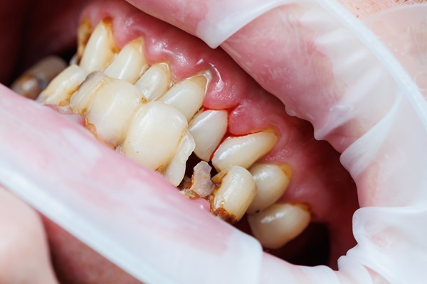 Can A Dentist Save A Cracked Tooth?