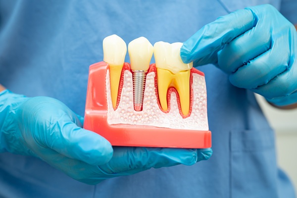 A Dental Implant Is A Permanent Tooth Replacement