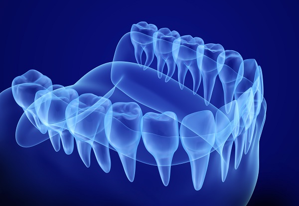 A Look At Implant Supported Dentures: Roots, Jawbone And Dentures