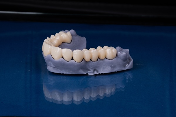 An Overview Of The Full Mouth Reconstruction Treatment Process