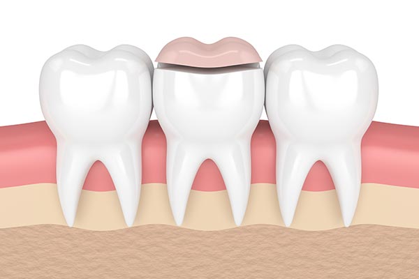 How a Cosmetic Dentist Can Place Inlays and Onlays from White Flint Family Dental in Rockville, MD
