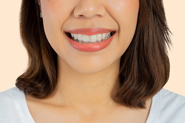 Invisalign Teeth Straightening is More Comfortable than Braces from White Flint Family Dental in Rockville, MD